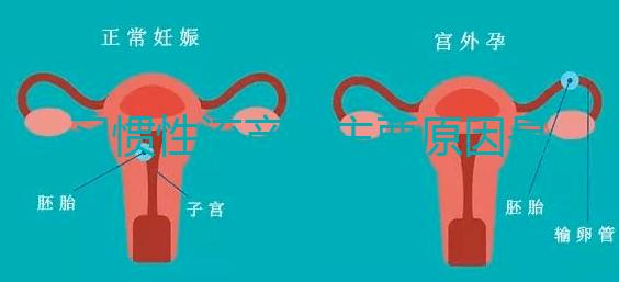 習慣性流產(chǎn)的主要原因是什么？