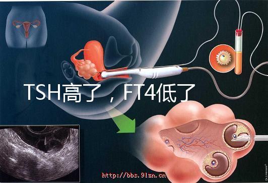 TSH高了，F(xiàn)T4低了，需要補碘嗎？